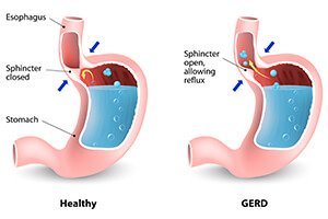 gastroesophageal reflux disease