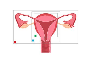 types of hysterectomy