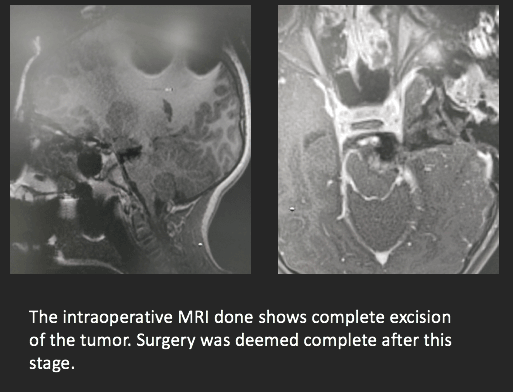 intraoperative mri