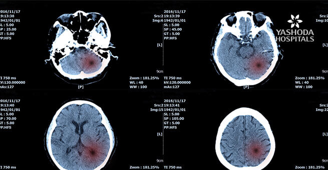 Brain tumor daignosis