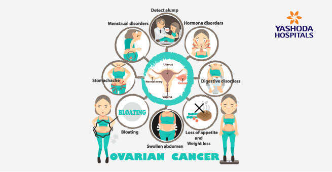 overian cancer