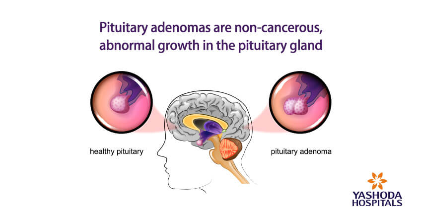 Pituitary adenoma