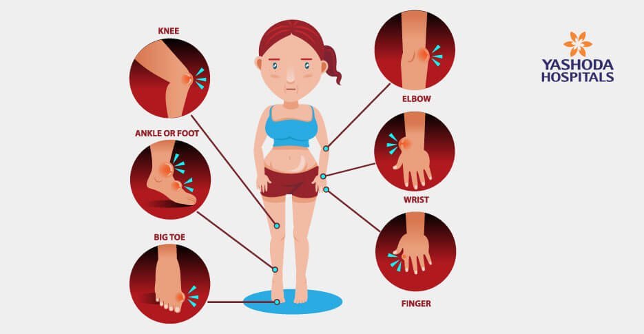 signs and symptoms of gout