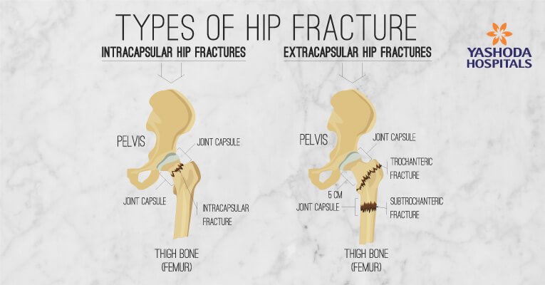 Hip Fracture: symptoms, causes, diagnosis, treatment, risk factors