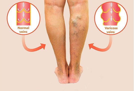 varicose veins surgery cost in Hyderabad