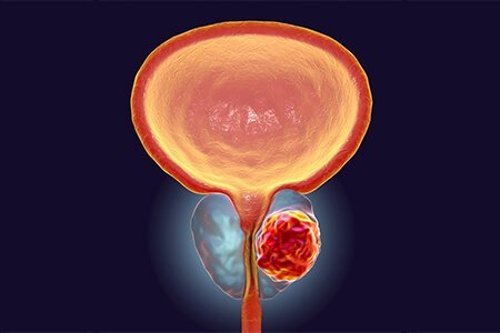 What is prostate cancer?